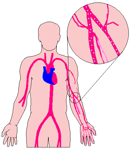 Decompression Sickness Bends. Decompression Sickness